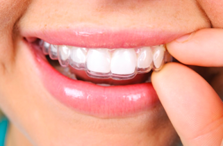 Zahnkorrektur mit Schienentherapie – ideal für Berufstätige!